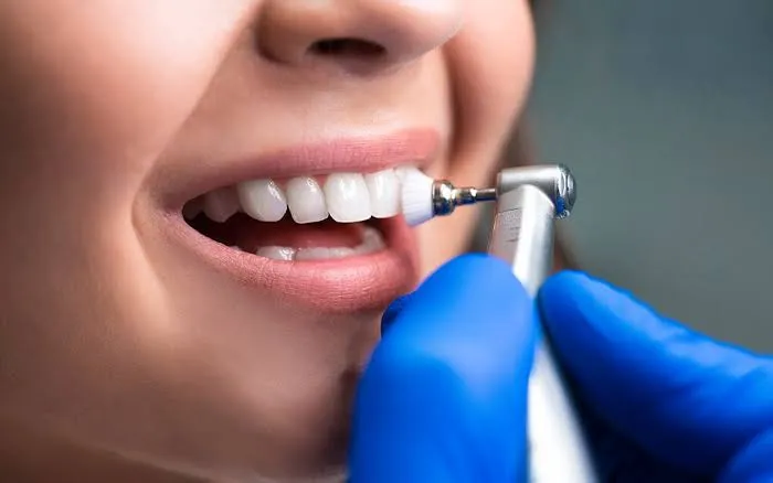 Limpieza de Caries